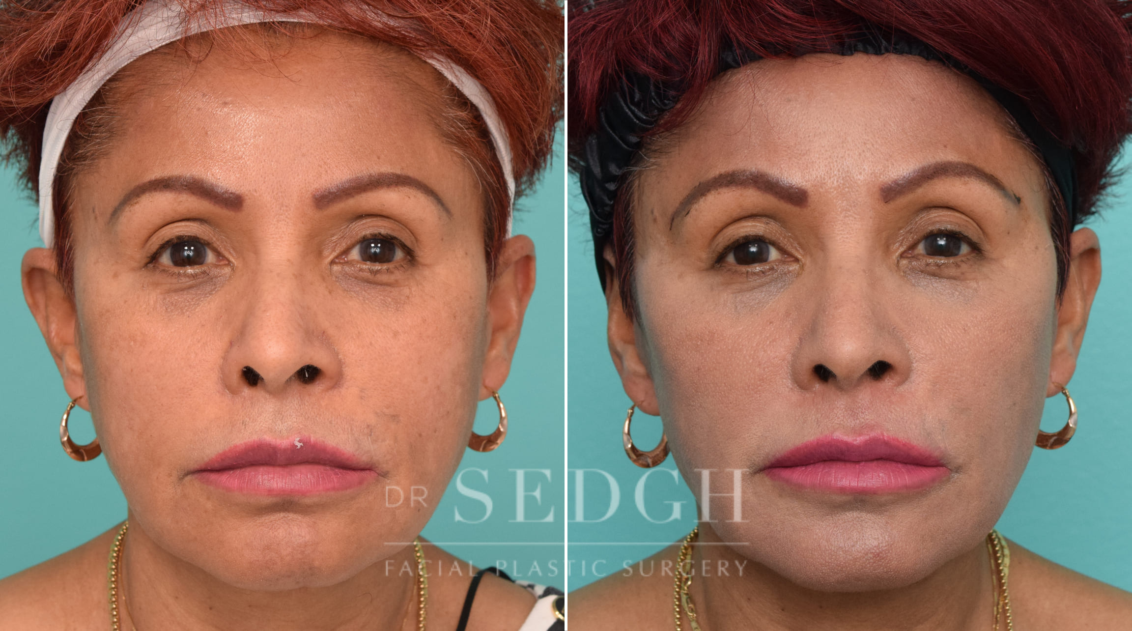 Female Patient Before and After Revision Facelift, Mini Facelift, Fat Grafting | Sedgh