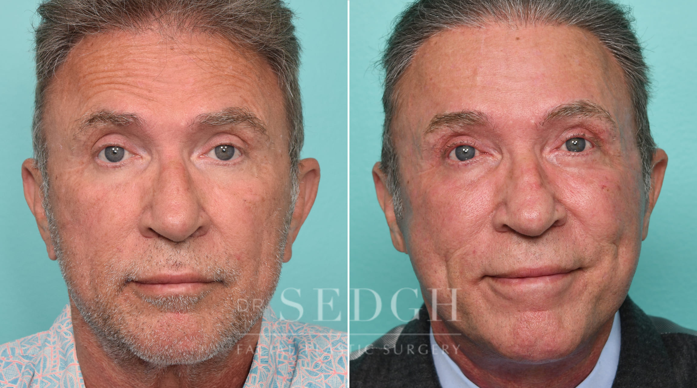 Male Patient Before and After Brow lift, Upper Blepharoplasty and Revision Facelift | Sedgh