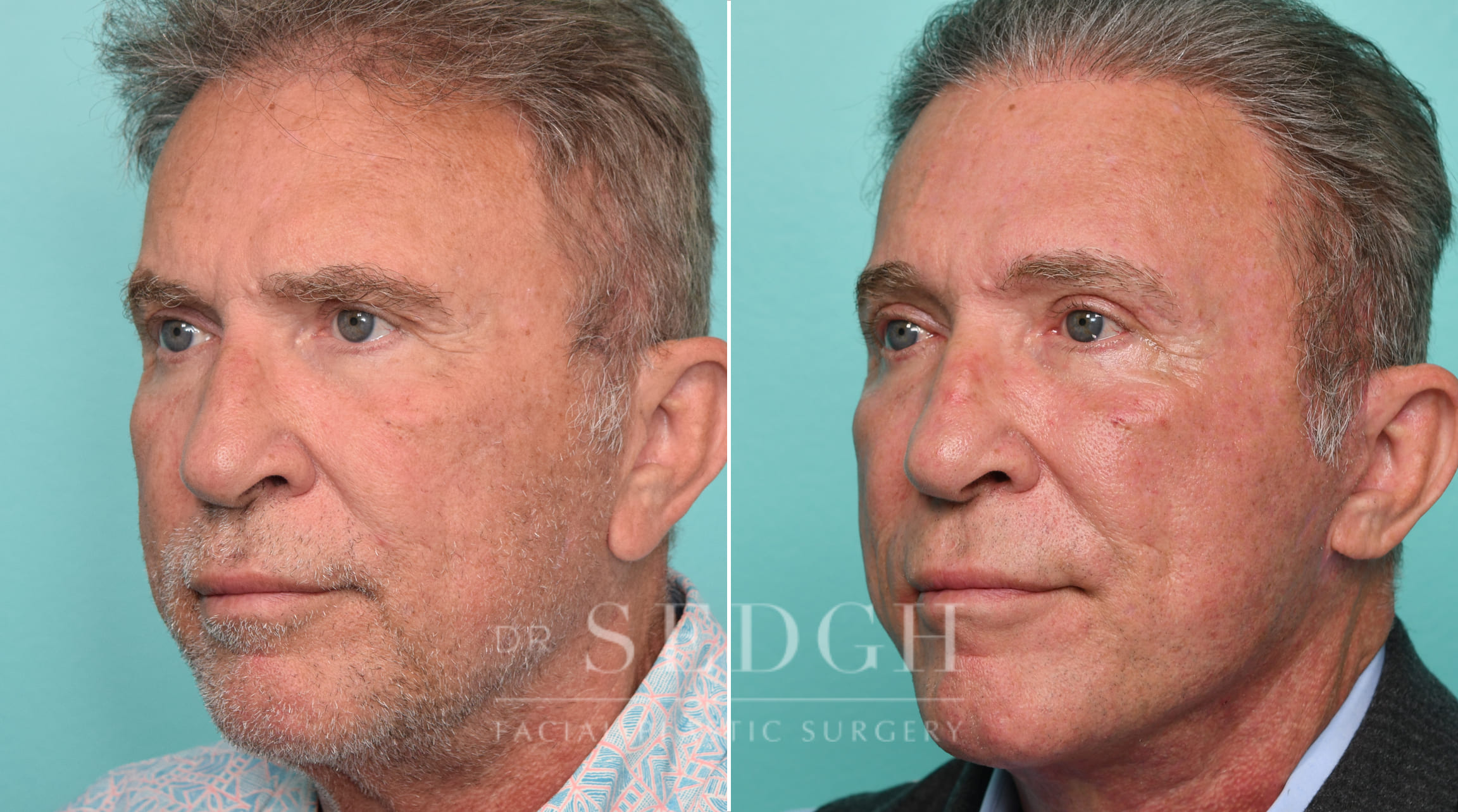 Male Patient Before and After Brow lift, Upper Blepharoplasty and Revision Facelift | Sedgh