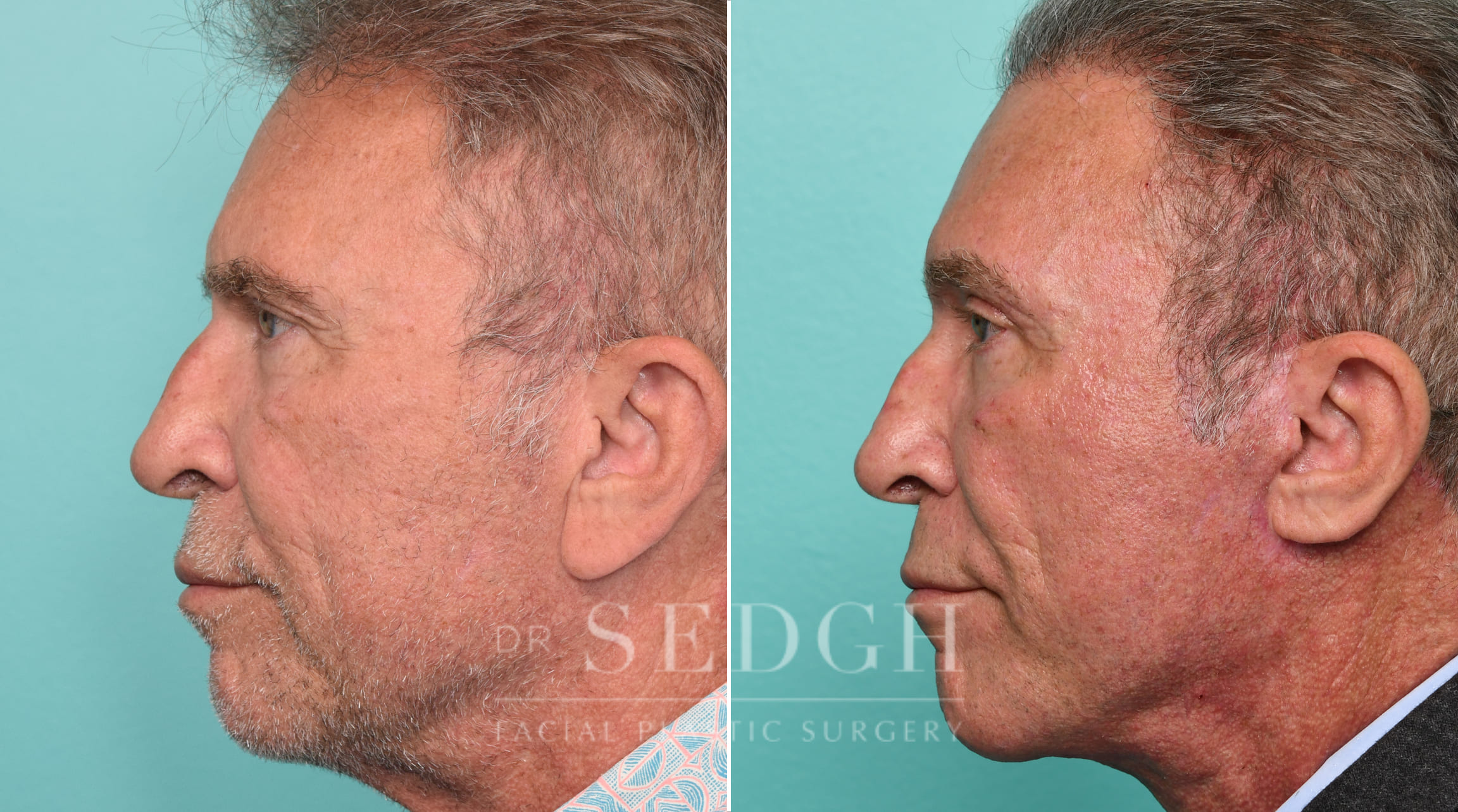 Male Patient Before and After Brow lift, Upper Blepharoplasty and Revision Facelift | Sedgh