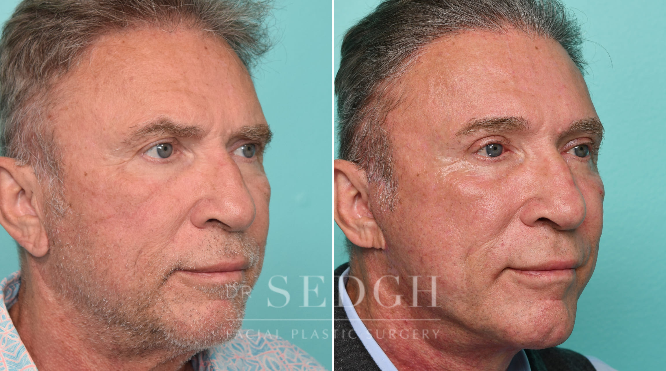 Male Patient Before and After Brow lift, Upper Blepharoplasty and Revision Facelift | Sedgh