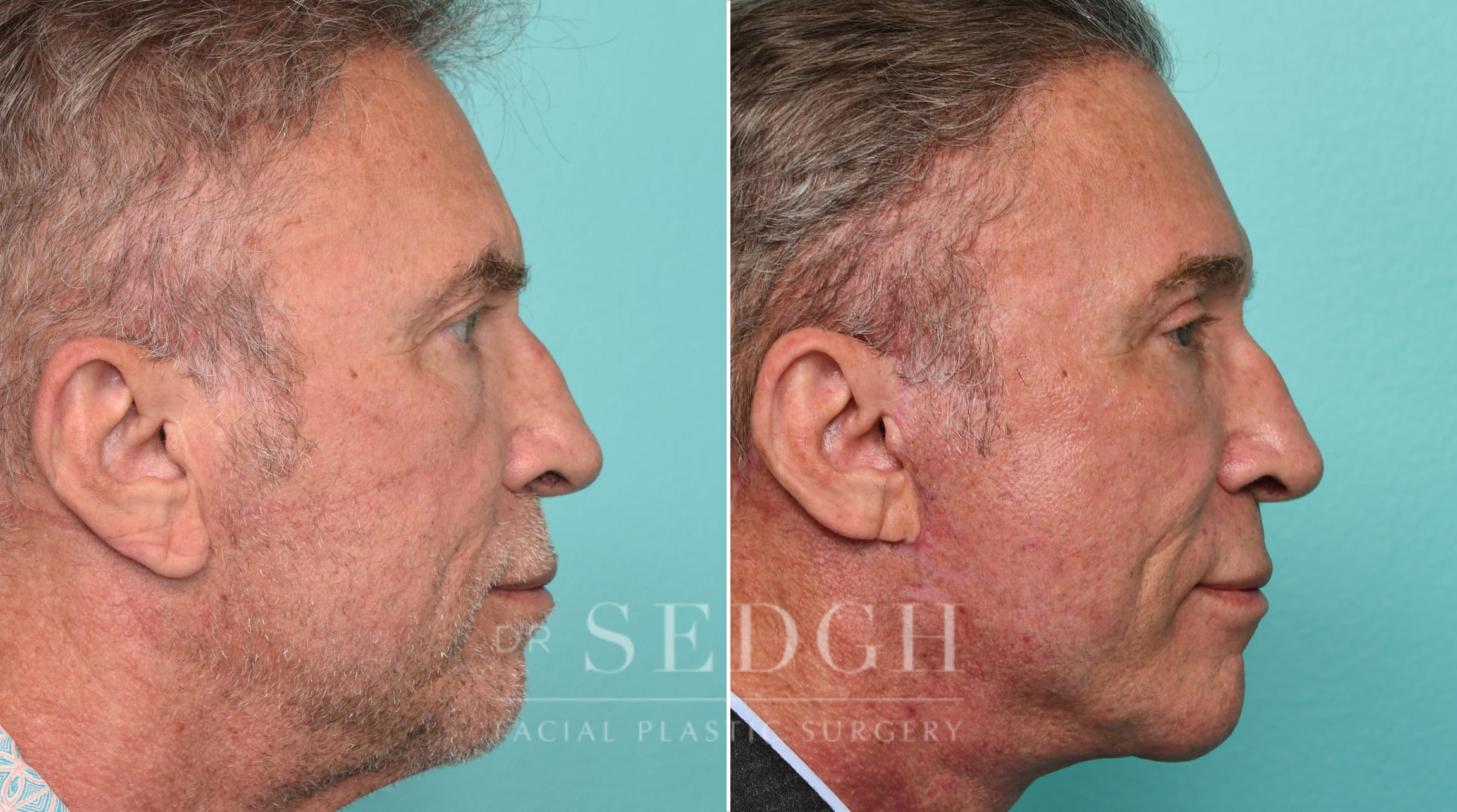 Male Patient Before and After Brow lift, Upper Blepharoplasty and Revision Facelift | Sedgh