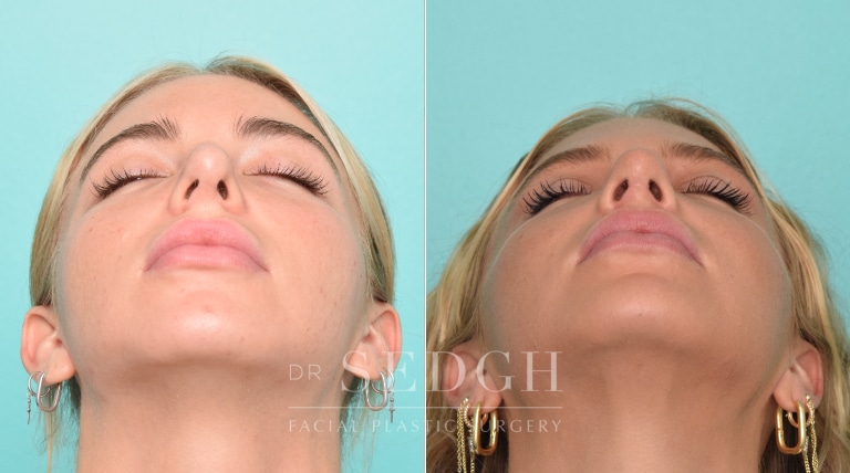 🥇 Revision Rhinoplasty Before & After Photos