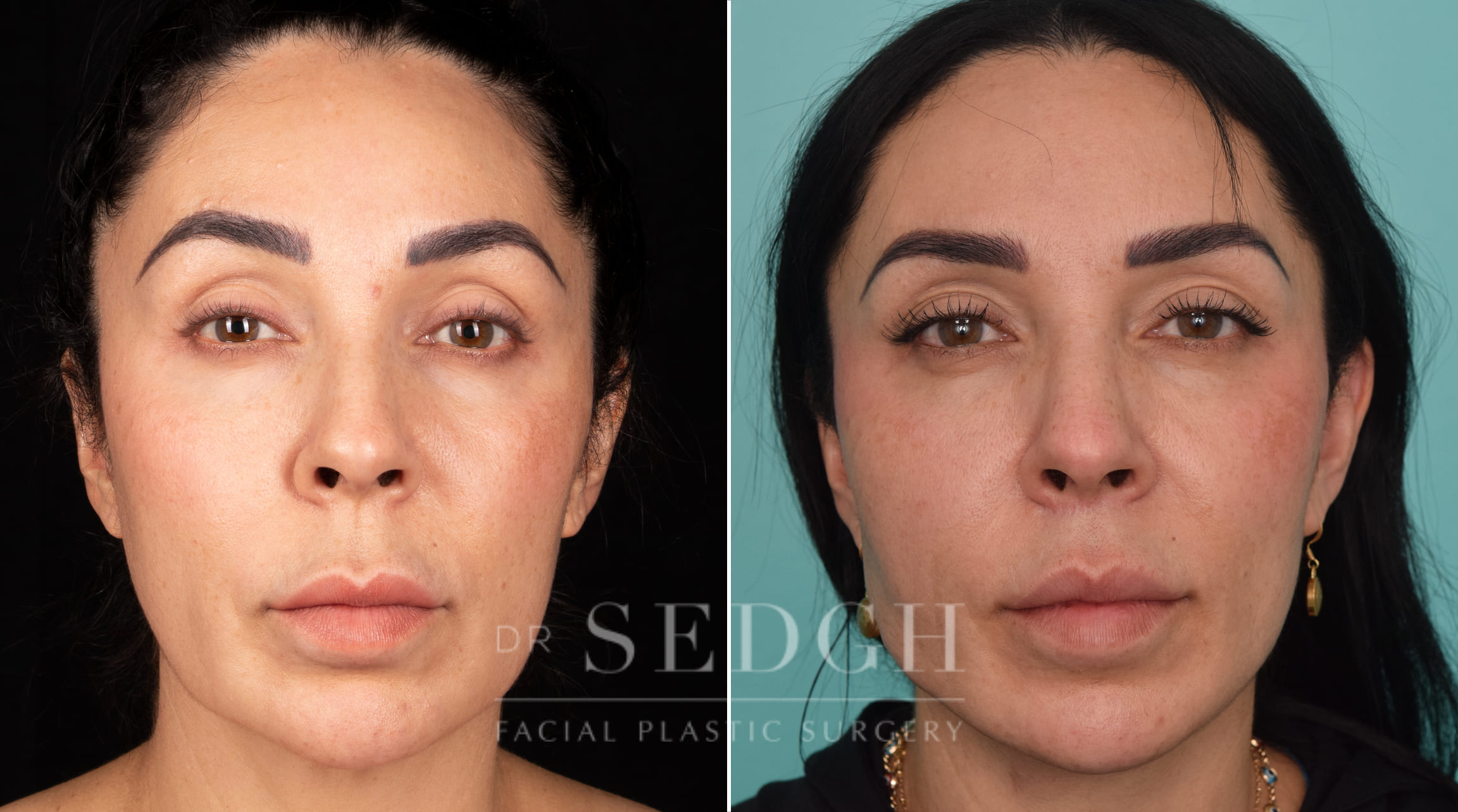 patient before and after mini-facelift procedure