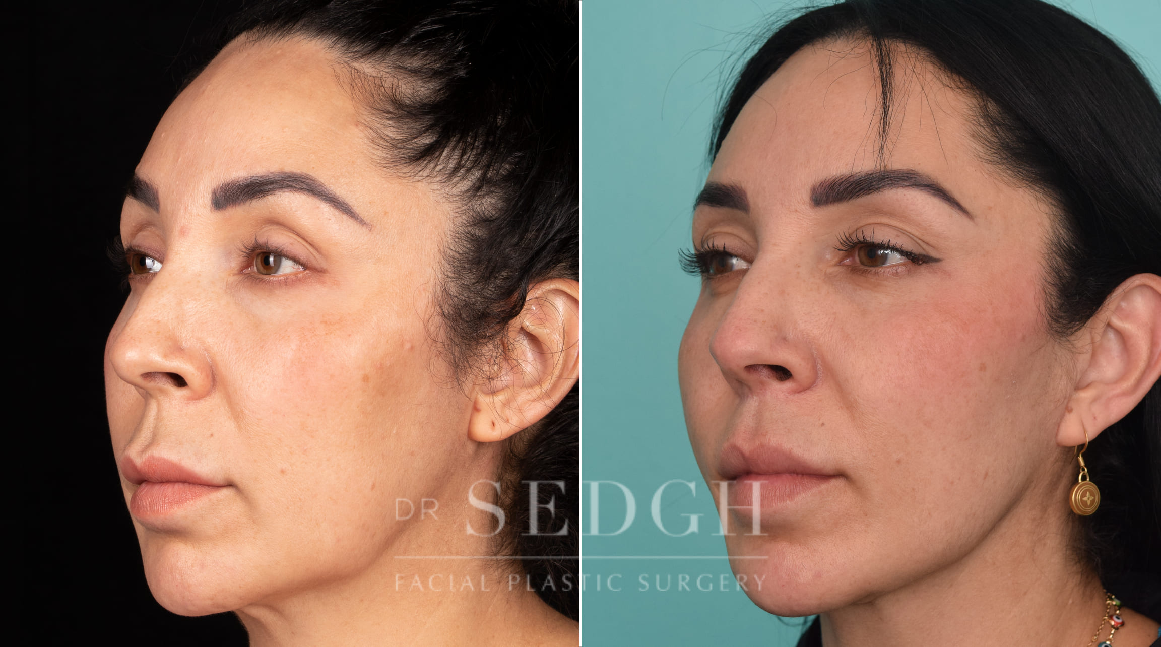 patient before and after mini-facelift procedure