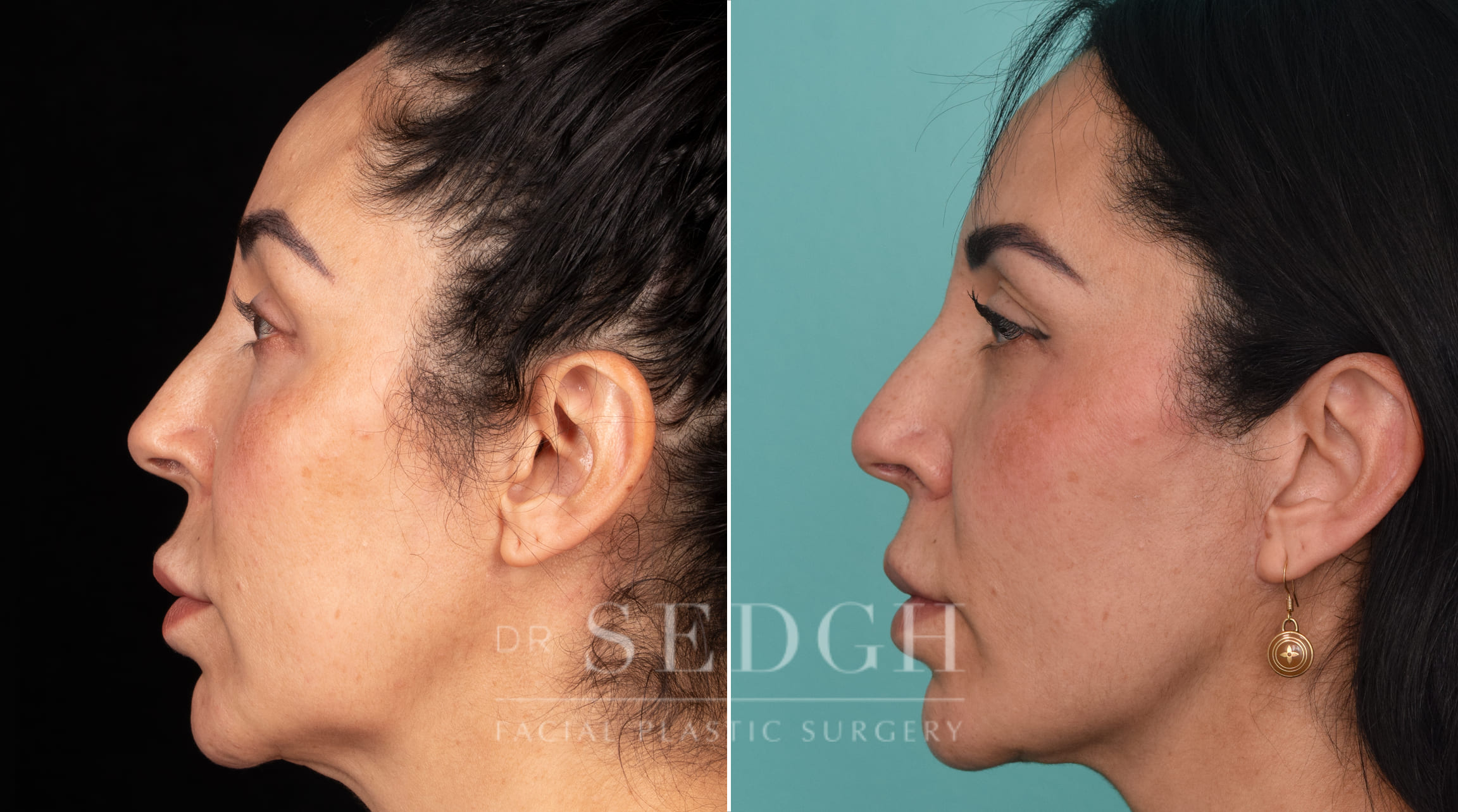 patient before and after mini-facelift procedure