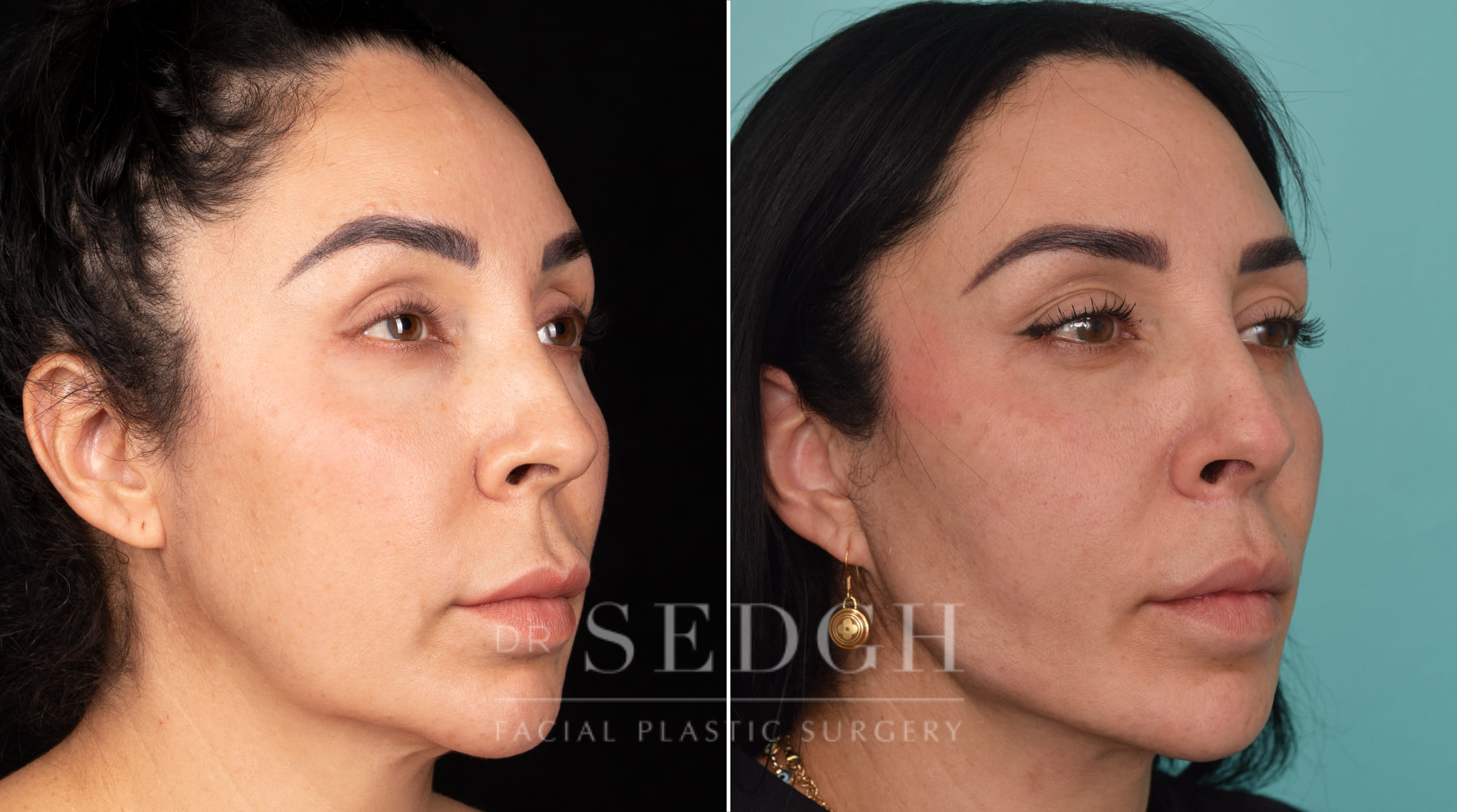 patient before and after mini-facelift procedure