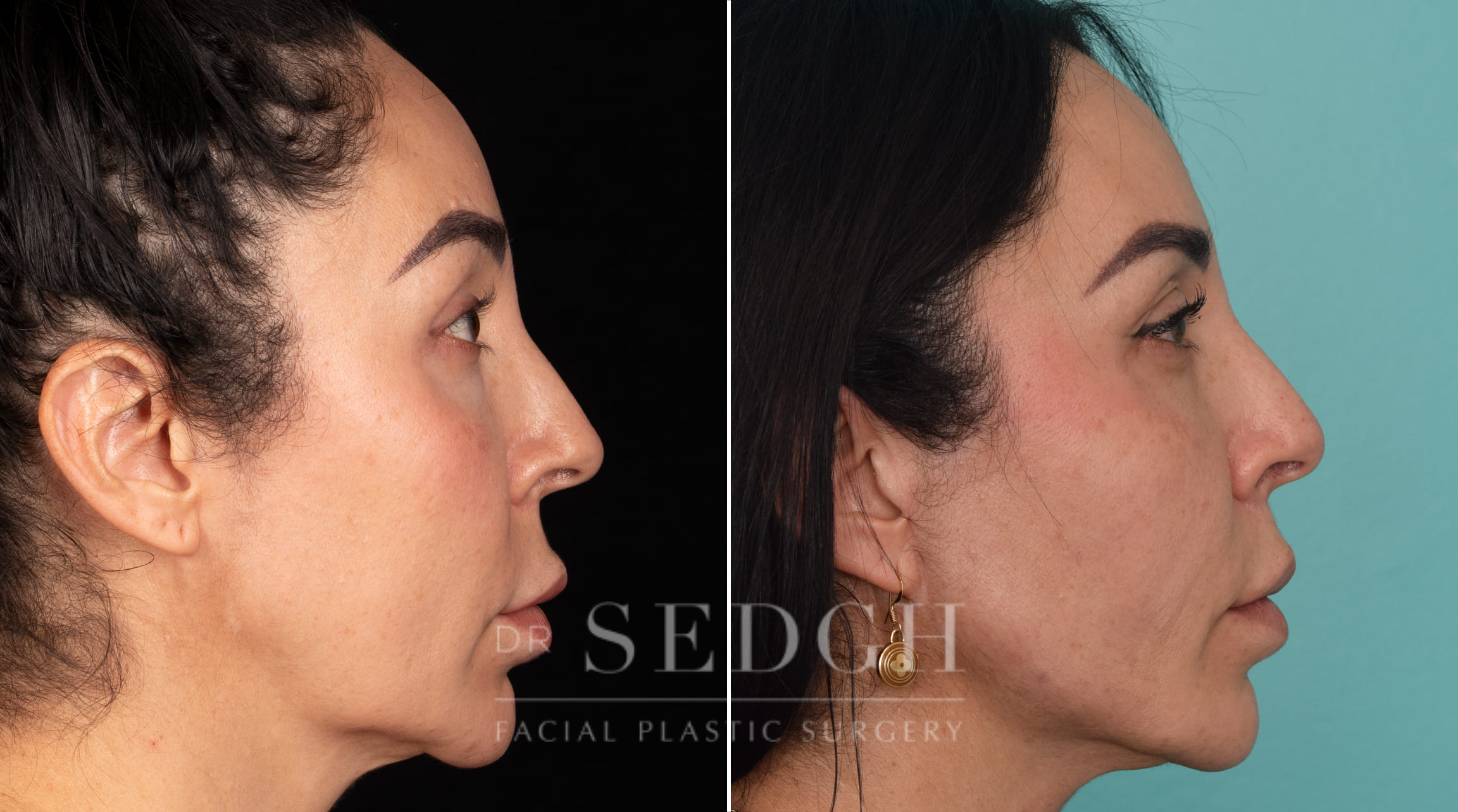 patient before and after mini-facelift procedure