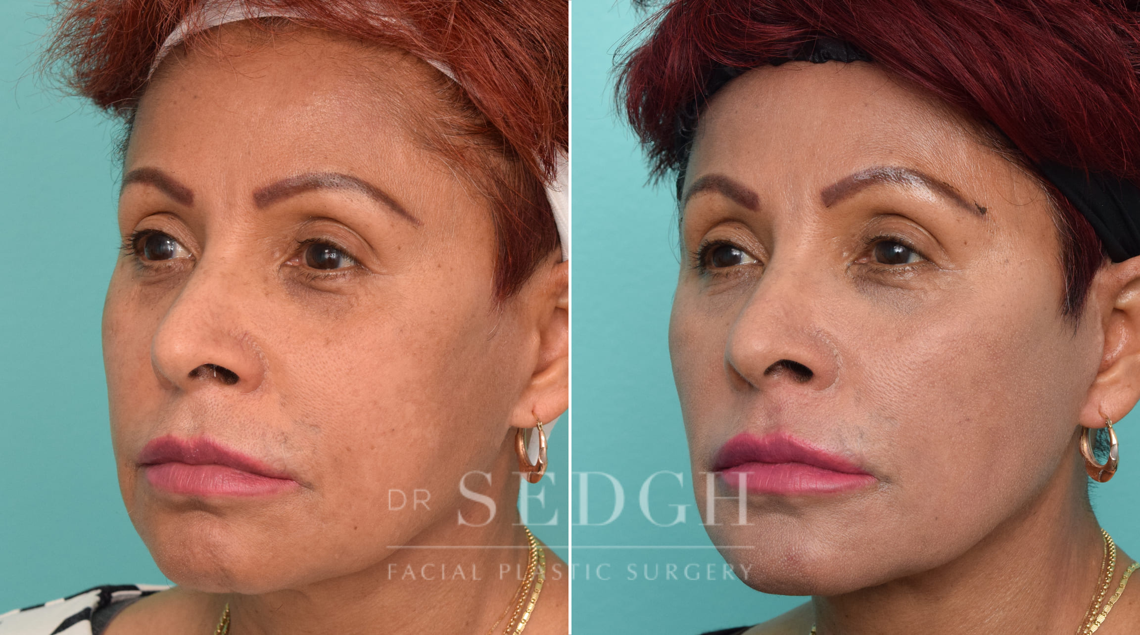 Female Patient Before and After Revision Facelift, Mini Facelift, Fat Grafting | Sedgh