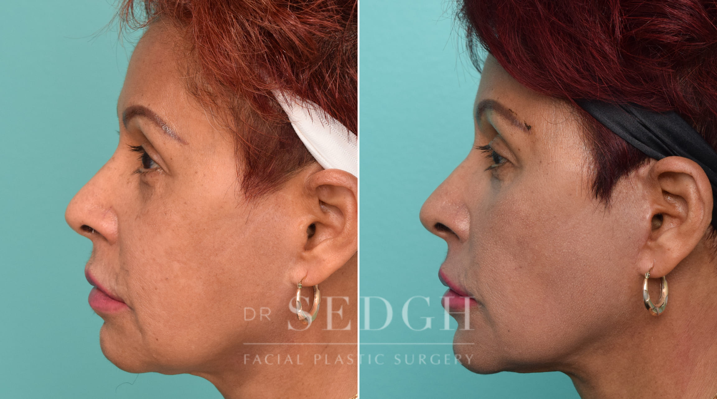 Female Patient Before and After Revision Facelift, Mini Facelift, Fat Grafting | Sedgh