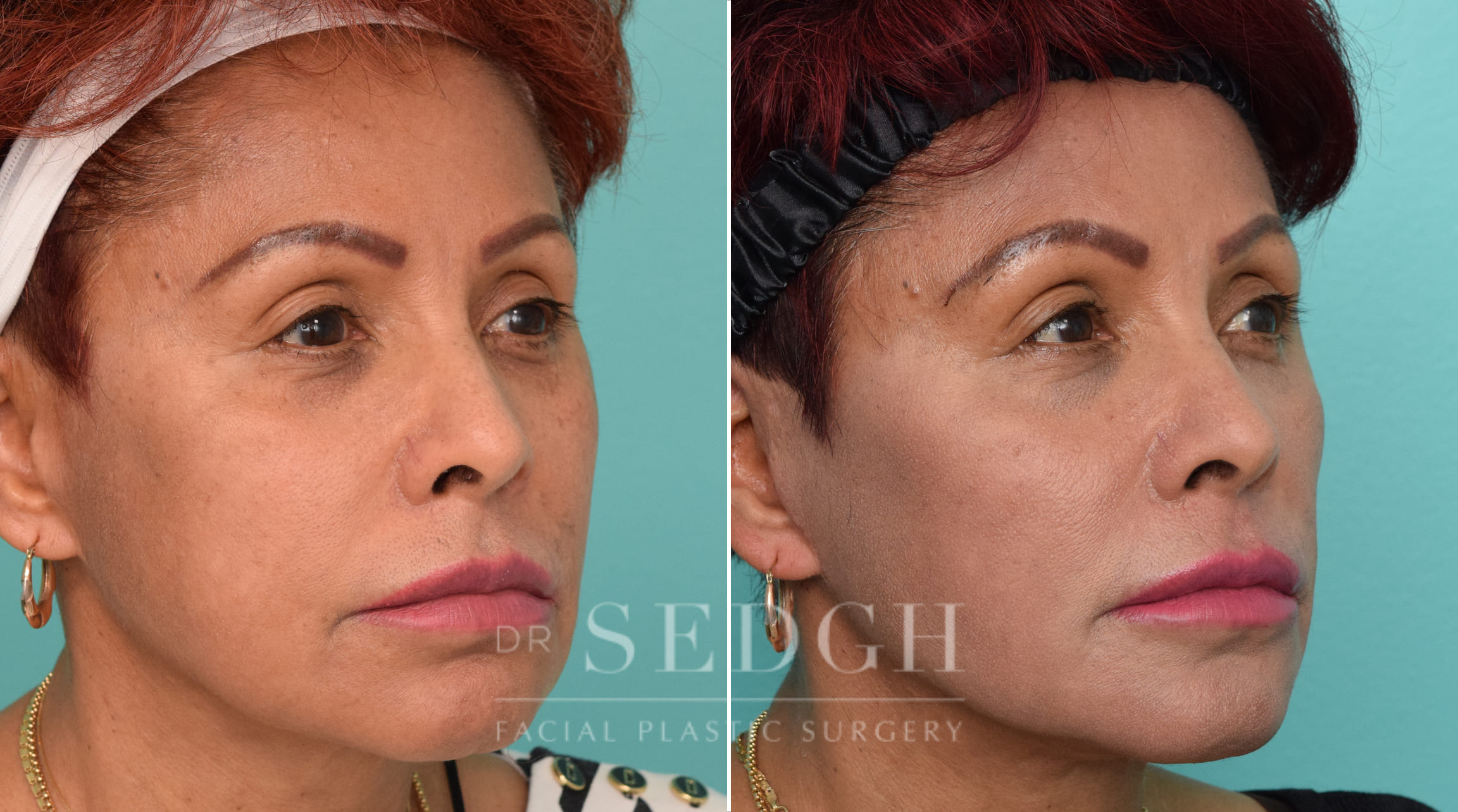 Female Patient Before and After Revision Facelift, Mini Facelift, Fat Grafting | Sedgh