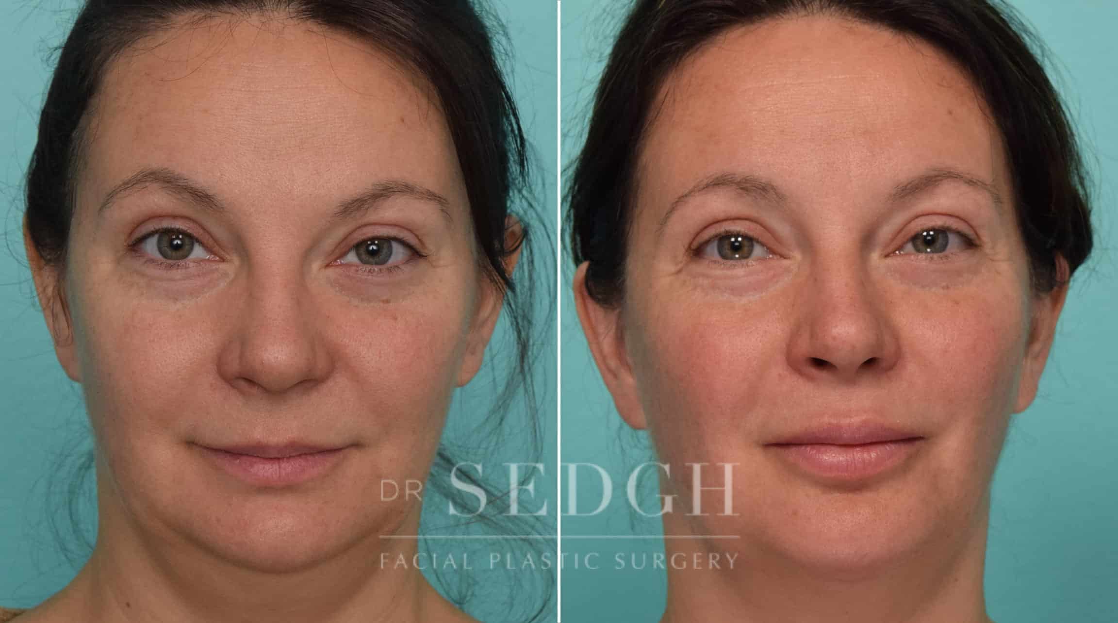 Female Patient Before and After Neck Lipo, FaceTite and Chin Augmentation | Sedgh