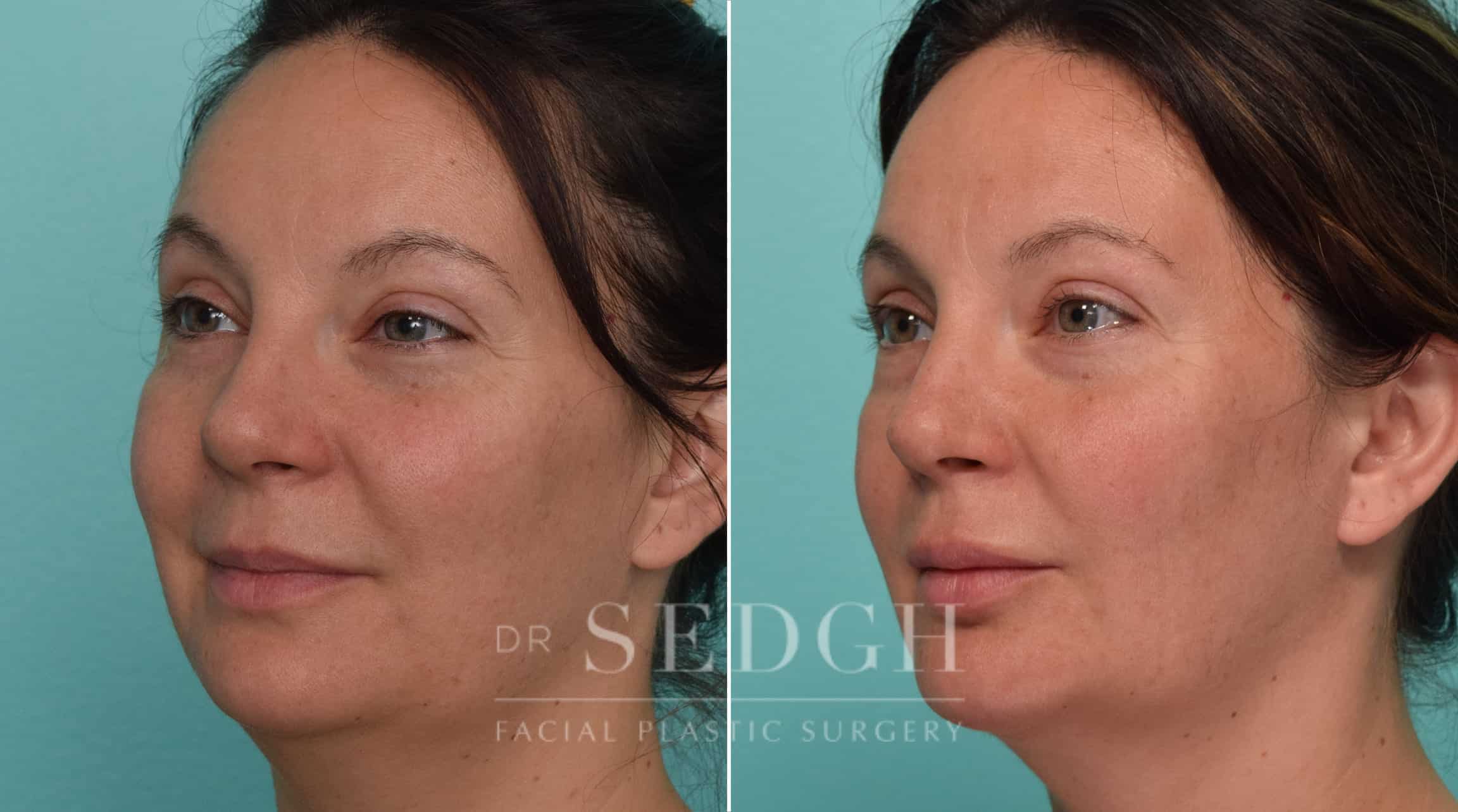 Female Patient Before and After Neck Lipo, FaceTite and Chin Augmentation | Sedgh