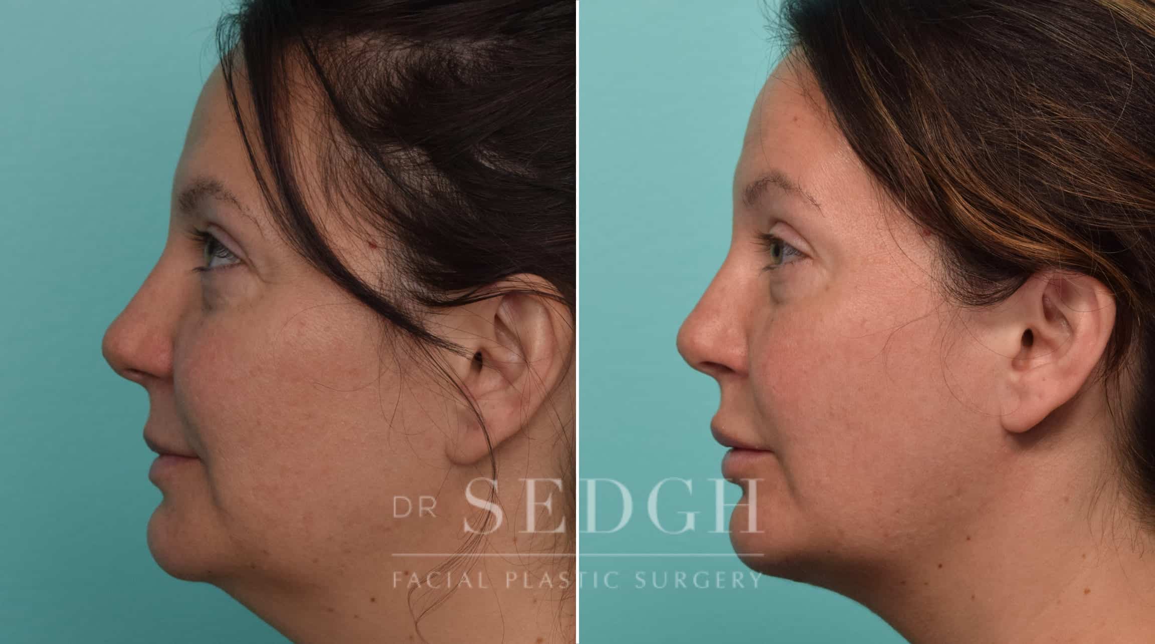 Female Patient Before and After Neck Lipo, FaceTite and Chin Augmentation | Sedgh