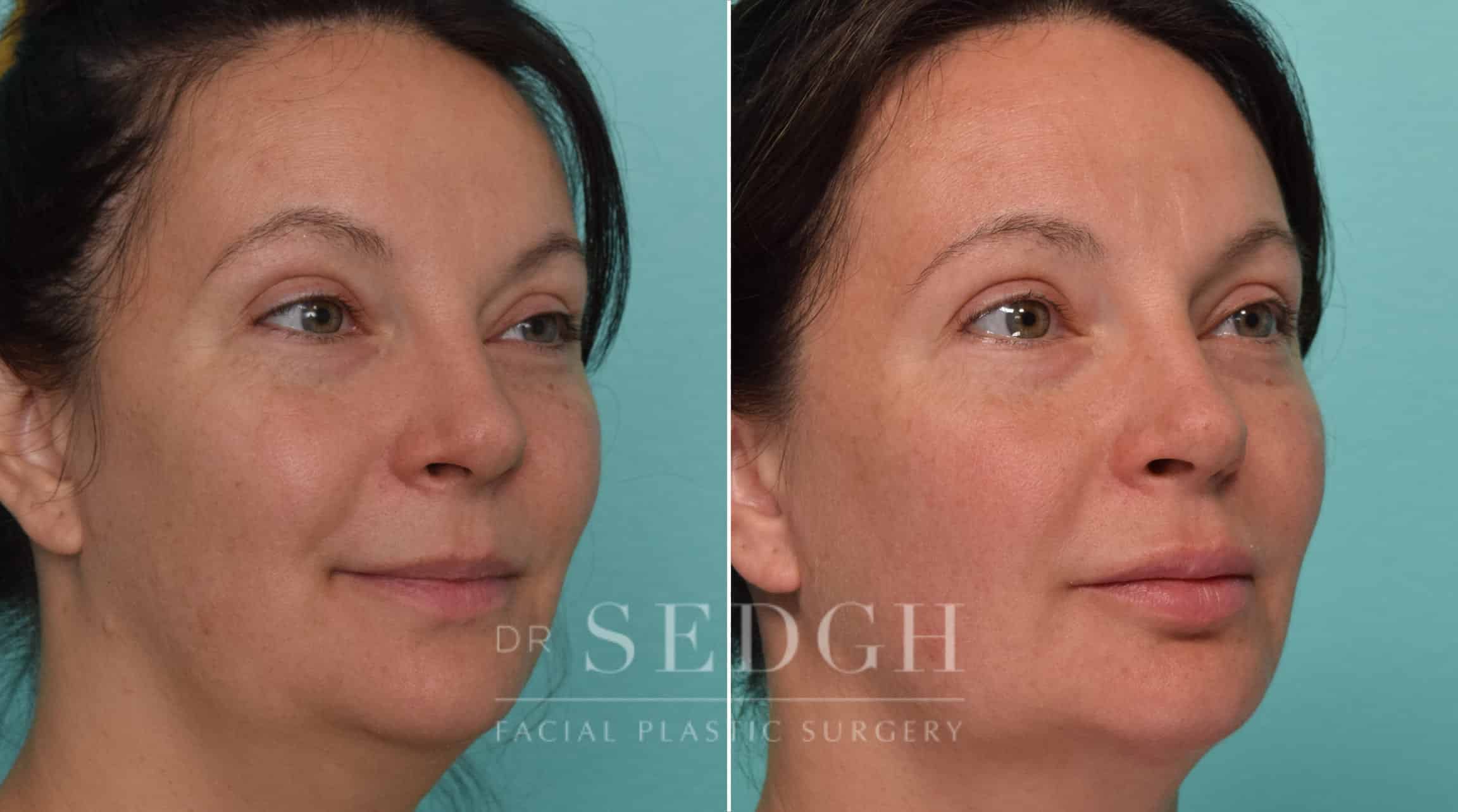 Female Patient Before and After Neck Lipo, FaceTite and Chin Augmentation | Sedgh