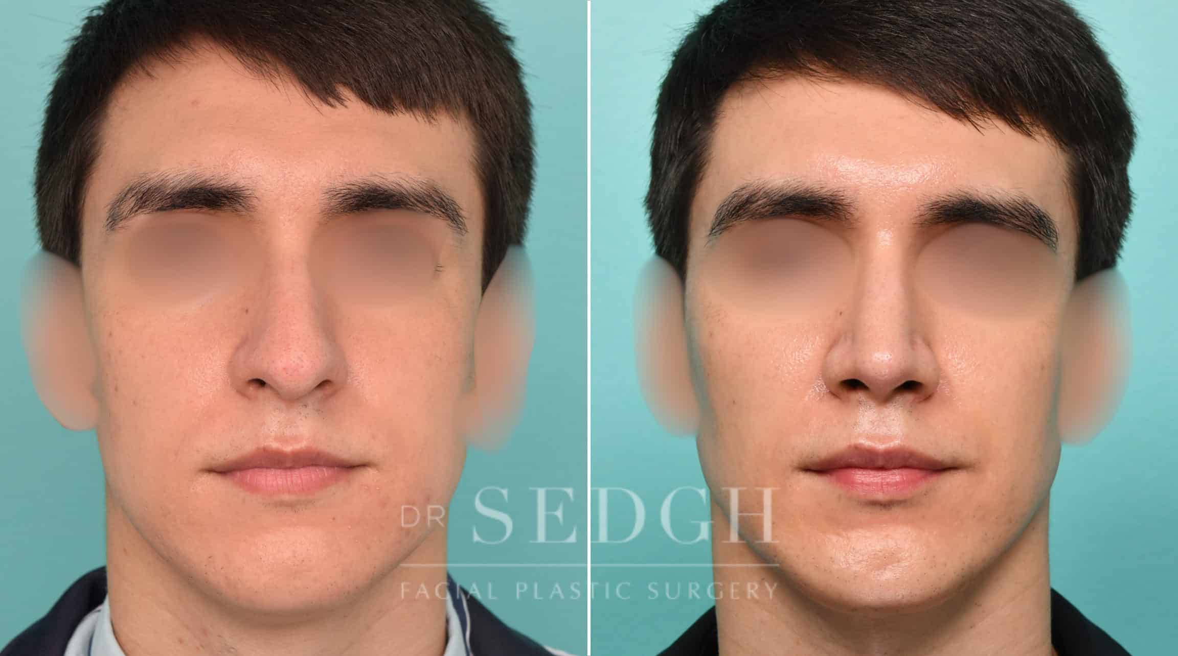 Male Patient Before and After Male Rhinoplasty, Chin Augmentation, and Facetite | Sedgh