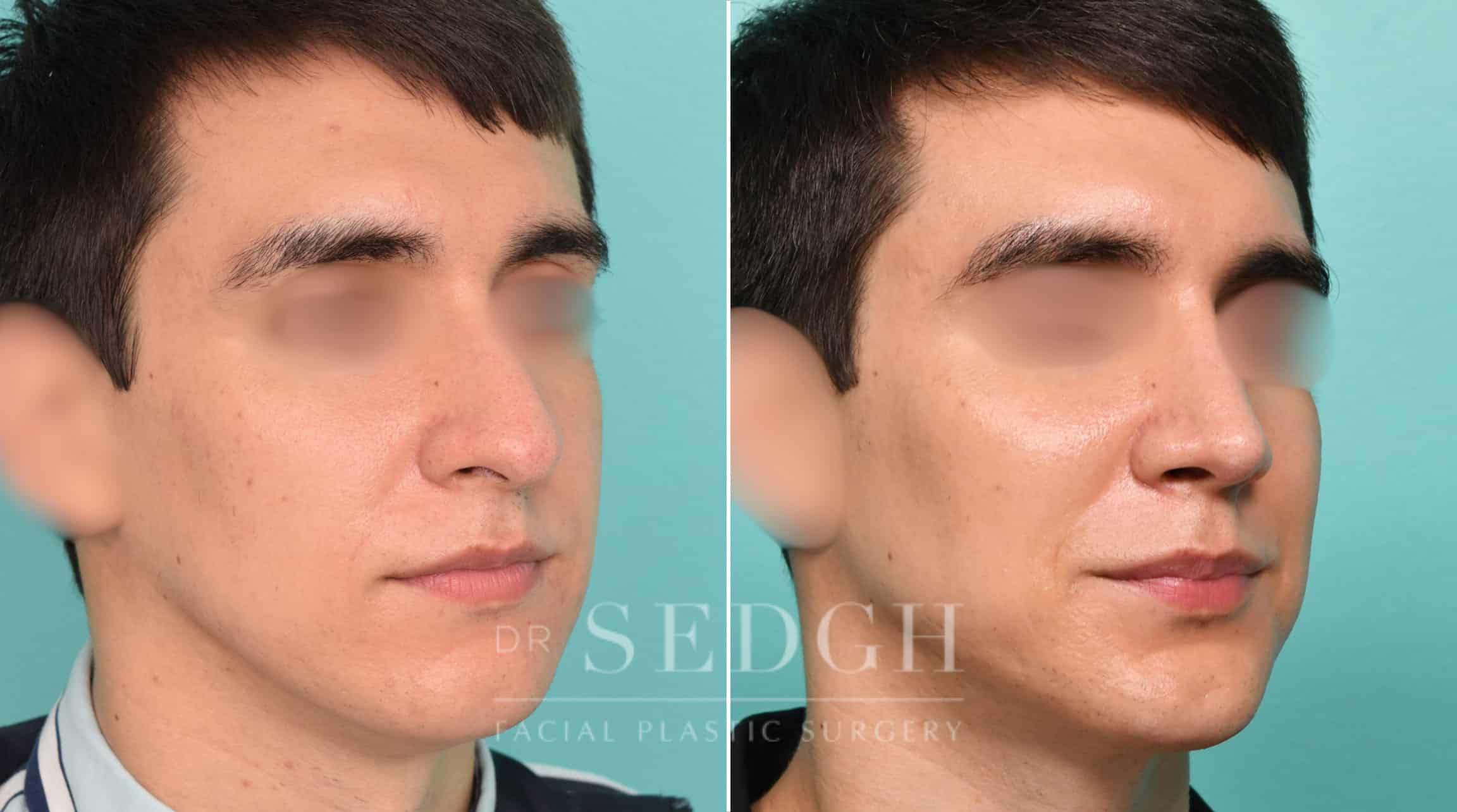 Male Patient Before and After Male Rhinoplasty, Chin Augmentation, and Facetite | Sedgh