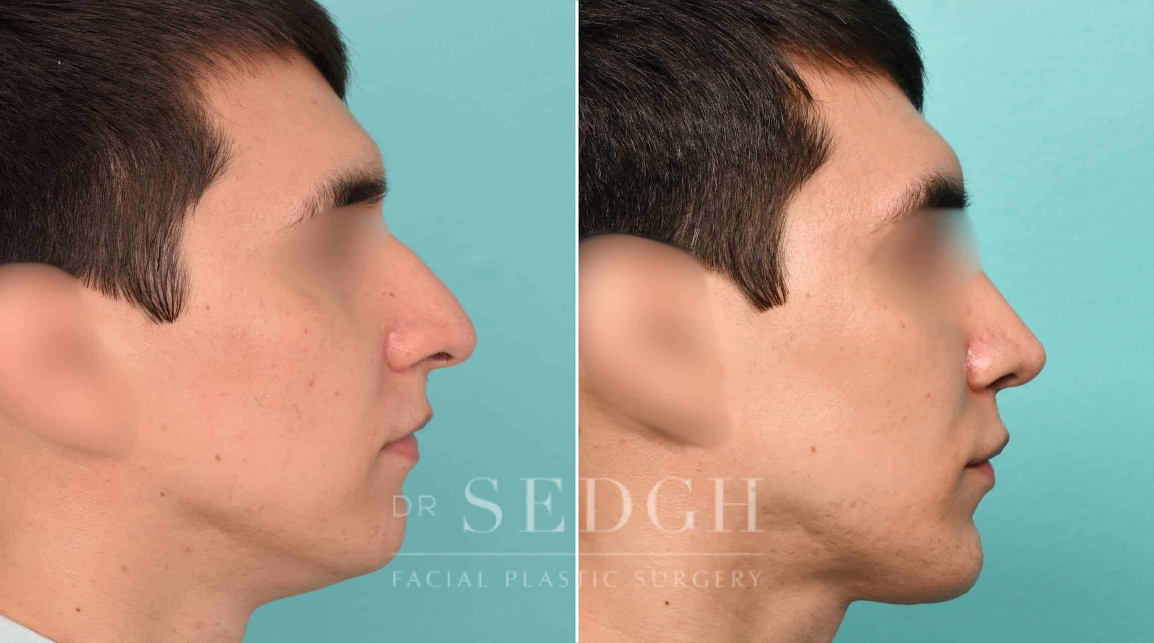 Male Patient Before and After Male Rhinoplasty, Chin Augmentation, and Facetite | Sedgh